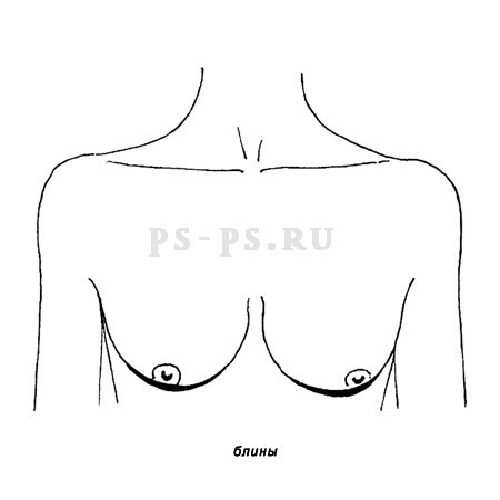 Женская грудь в форме "блины"