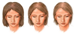 Причины диффузного выпадения волос