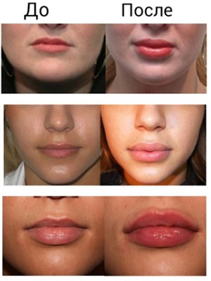 Фото до и после увеличения губ